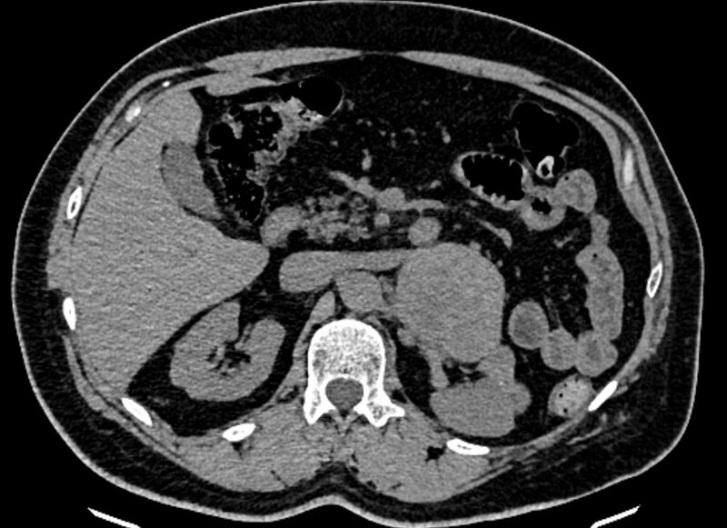 File:Adrenal metastases (Radiopaedia 73082-83791 Axial non-contrast 65).jpg