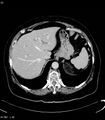 Adrenal myelolipoma (Radiopaedia 6765-7960 Axial C+ arterial phase 4).jpg