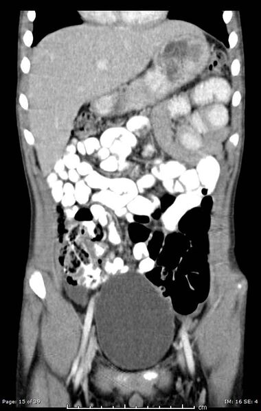 File:Agenesis of the gallbladder (Radiopaedia 55454-61905 A 15).jpg
