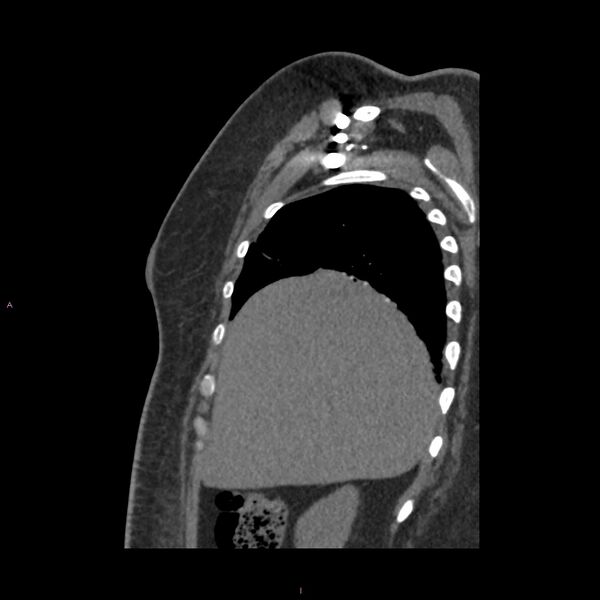 File:Agenesis of the left hepatic lobe (Radiopaedia 77284-89359 Sagittal C+ CTPA 19).jpg