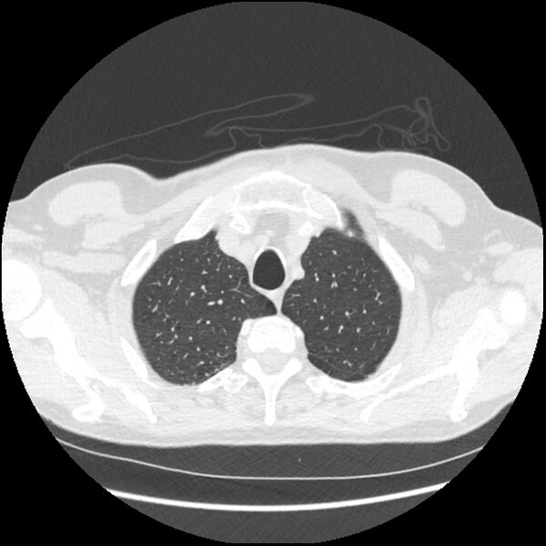 File:Alpha-1-antitrypsin deficiency (Radiopaedia 40993-43722 Axial lung window 28).jpg