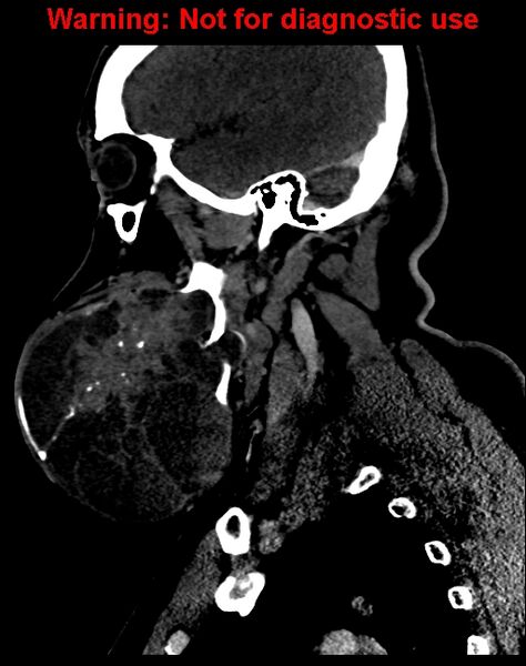 File:Ameloblastoma (Radiopaedia 33126-34164 F 22).jpg