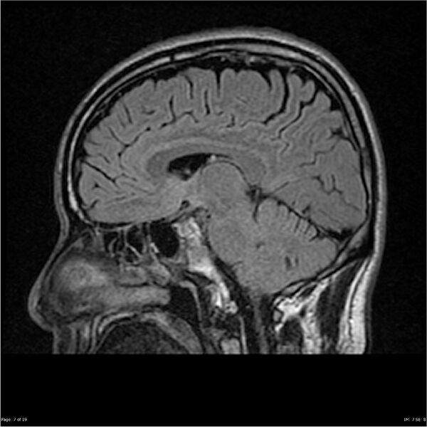 File:Amnestic syndrome secondary to hypoxic brain injury (Radiopaedia 24743-25004 D 7).jpg