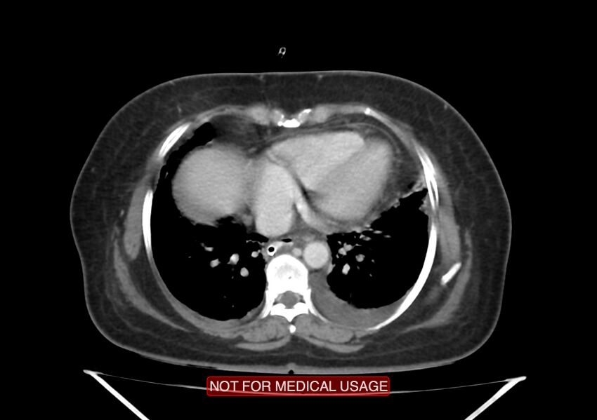 Amoebic enterocolitis with liver abscess (Radiopaedia 35100-36609 A 5).jpg