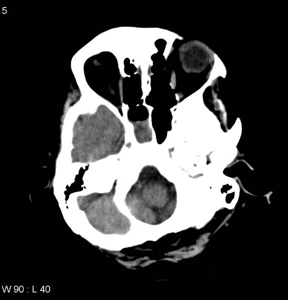 File:Anaplastic astrocytoma NOS (Radiopaedia 40188-42698 Axial non-contrast 5).jpg