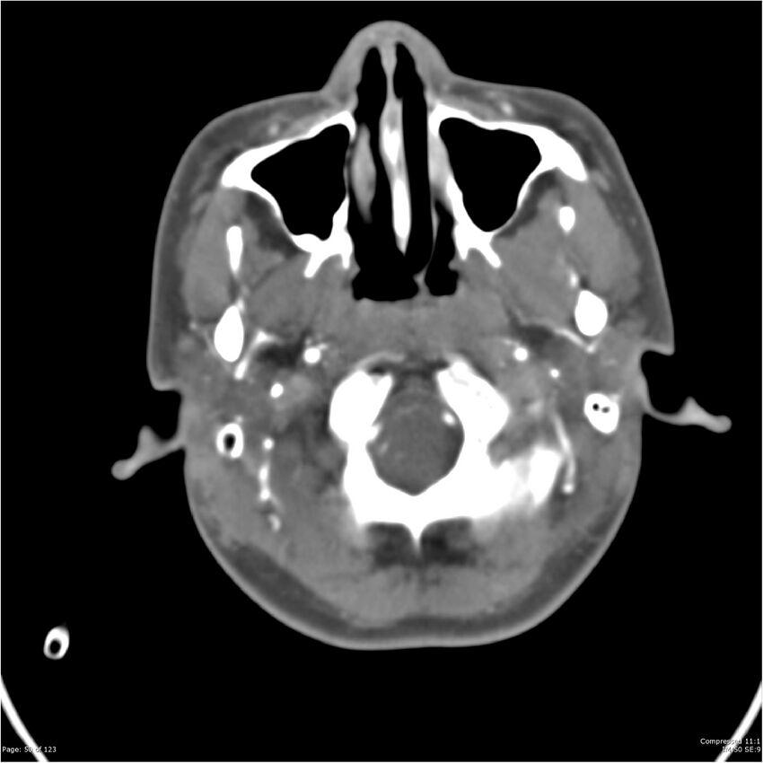 Aneurysmal subarachnoid hemorrhage and Moya Moya disease (Radiopaedia 34306-35593 Axial CT COW 50).jpg