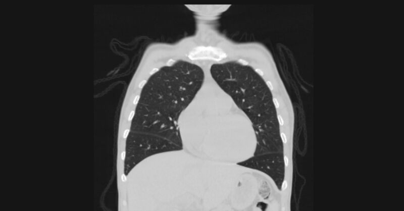 File:Angioinvasive aspergellosis (Radiopaedia 66995-76315 Coronal lung window 19).jpg