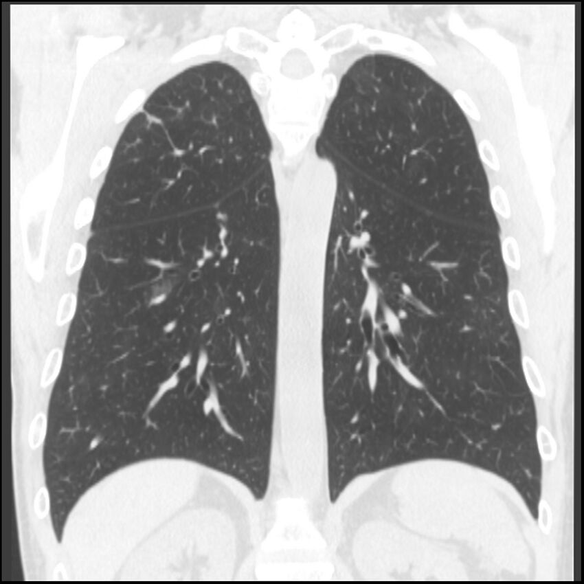 Angioinvasive aspergillosis (Radiopaedia 43957-47466 Coronal lung window 32).jpg