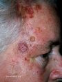 Angiosarcoma is twice as common in men than in women. Angiosarcoma of the head and neck mostly affects older people. (DermNet NZ vascular-angiosarcoma1).jpg