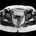 Ano-vaginal fistula (Radiopaedia 29765-30284 Axial T2 13).jpg