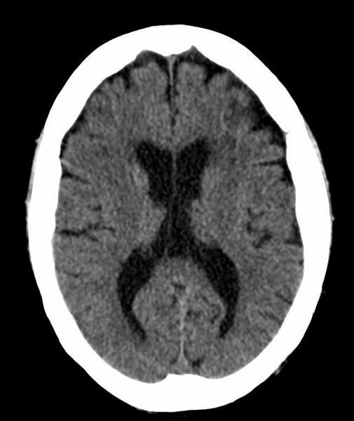 File:Anomalous intracranial venous drainage (Radiopaedia 28161-28418 Axial 22).png