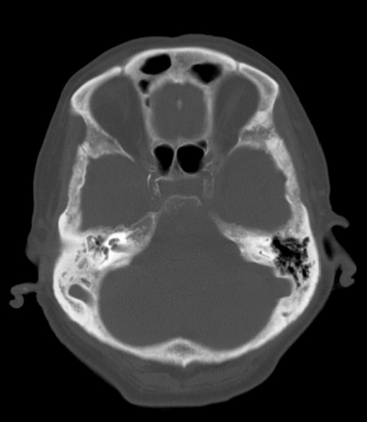 File:Anomalous intracranial venous drainage (Radiopaedia 28161-28418 Axial 3).png