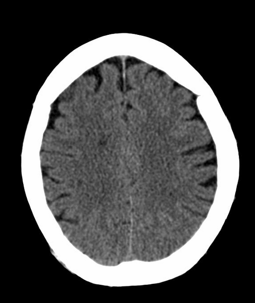 File:Anomalous intracranial venous drainage (Radiopaedia 28161-28418 Axial 36).png