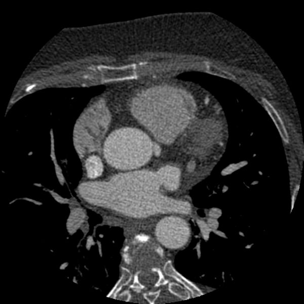 File:Anomalous origin of left circumflex artery from right coronary sinus (Radiopaedia 72563-83117 B 43).jpg