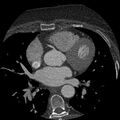 Anomalous origin of left circumflex artery from right coronary sinus (Radiopaedia 72563-83117 B 56).jpg