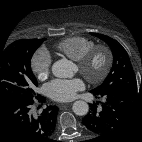 File:Anomalous origin of left circumflex artery from right coronary sinus (Radiopaedia 72563-83117 B 56).jpg