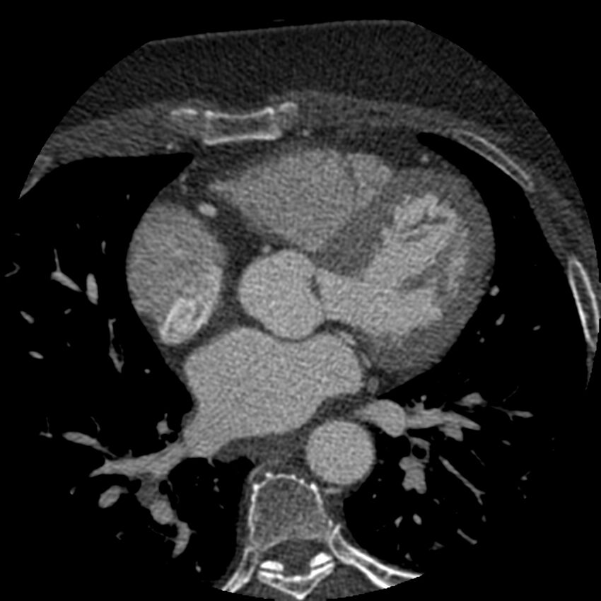 Anomalous origin of left circumflex artery from right coronary sinus (Radiopaedia 72563-83117 B 68).jpg