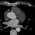 Anomalous origin of the left coronary artery with malignant course (Radiopaedia 77842-90126 C 65).jpeg