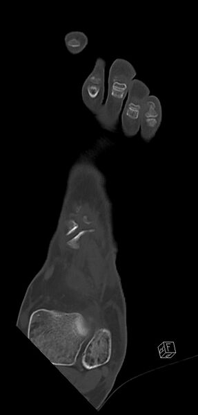 File:Anterior calcaneal process fracture (Radiopaedia 63353-71943 Coronal bone window 13).jpg