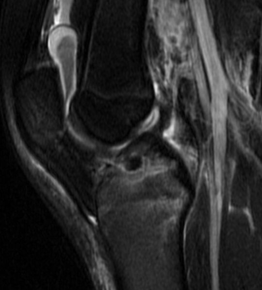 File:Anterior cruciate ligament bony avulsion (MRI) (Radiopaedia 14273-14151 Sagittal T2 fat sat 1).jpg