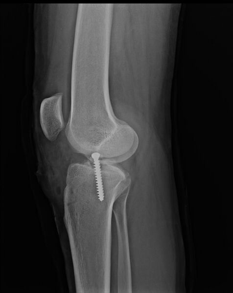 File:Anterior cruciate ligament bony avulsion (Radiopaedia 12579-12801 Lateral 1).jpg
