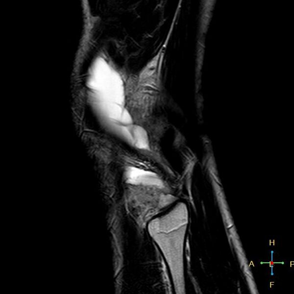 File:Anterior cruciate ligament tear - complete (Radiopaedia 24907-25170 Sagittal T2 1).jpg