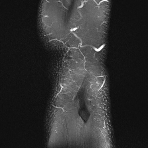 File:Anterior cruciate ligament tear - ramp lesion (Radiopaedia 71883-82322 Sagittal PD fat sat 1).jpg