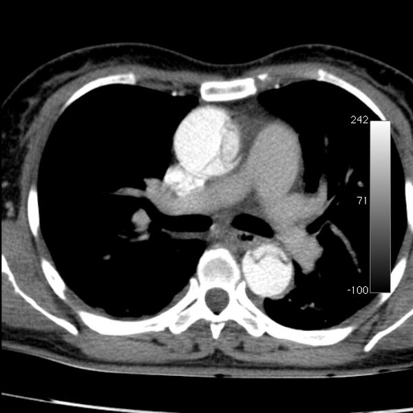 File:Aortic dissection - Stanford type A (Radiopaedia 29247-29659 A 33).jpg