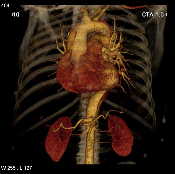 File:Aortic dissection with rupture into pericardium (Radiopaedia 12384-12647 C+ arterial phase 36).jpg
