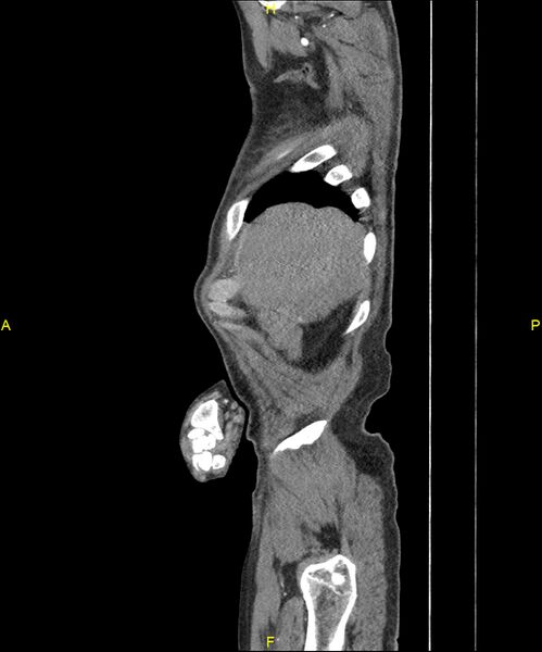 File:Aortoenteric fistula (Radiopaedia 84308-99603 C 34).jpg