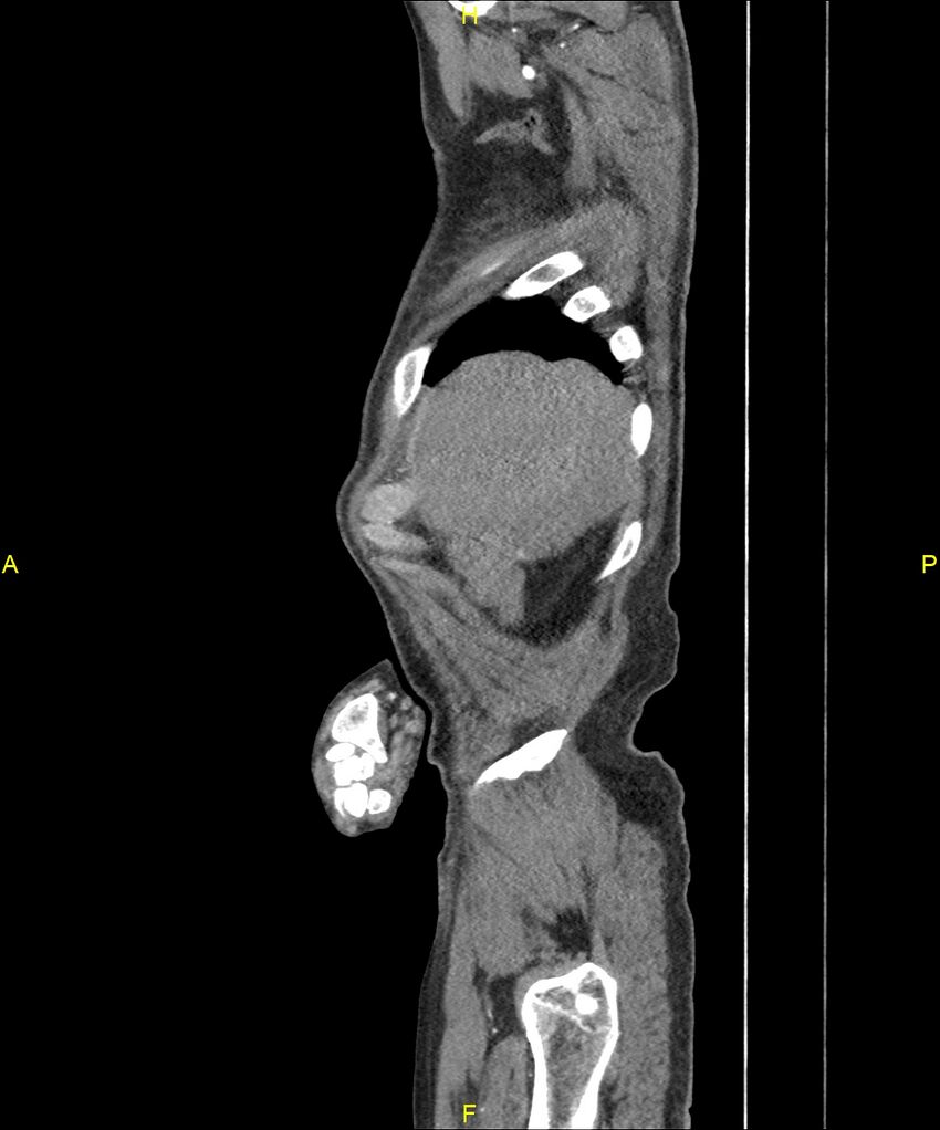 Aortoenteric fistula (Radiopaedia 84308-99603 C 34).jpg