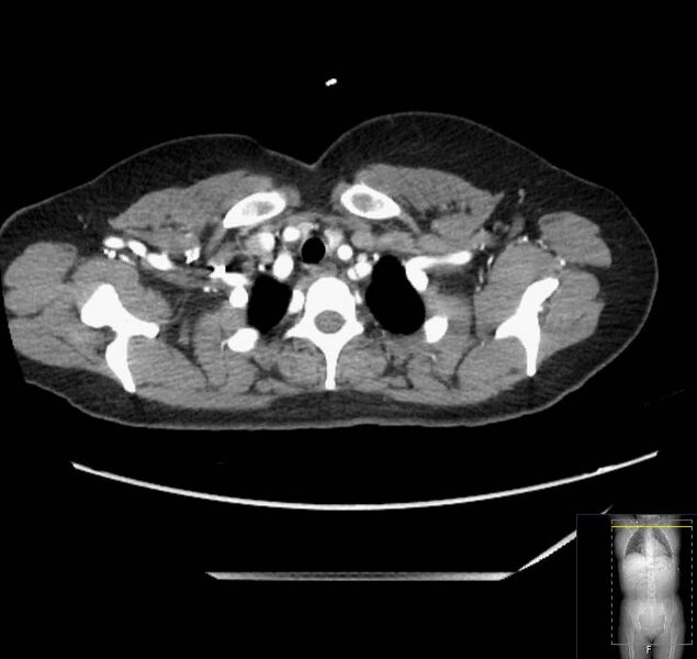 File:Appendicitis (CT angiogram) (Radiopaedia 154713-127660 Axial 235).jpg