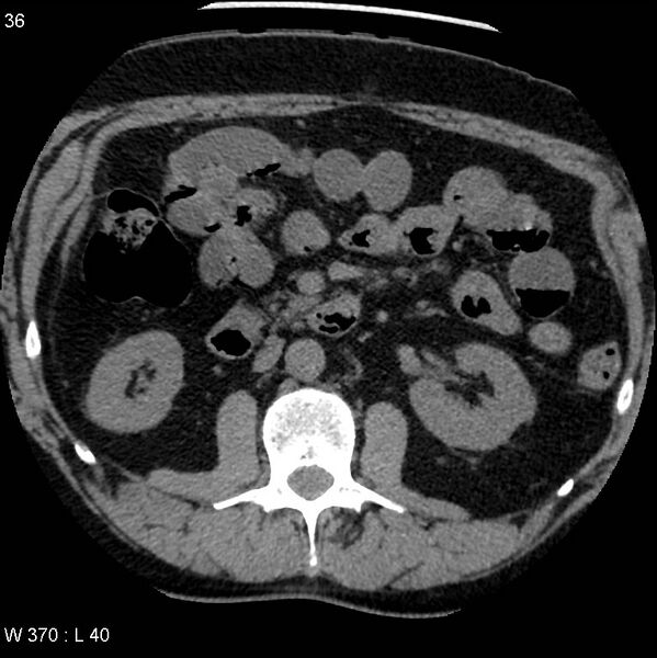 File:Appendicitis (Radiopaedia 12510-12733 Axial non-contrast 4).jpg