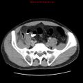 Appendicitis and renal cell carcinoma (Radiopaedia 17063-16760 A 43).jpg