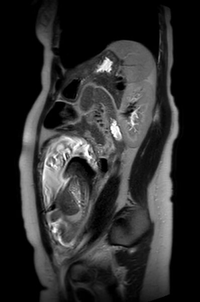 File:Appendicitis in gravida (MRI) (Radiopaedia 89433-106395 Sagittal T2 22).jpg