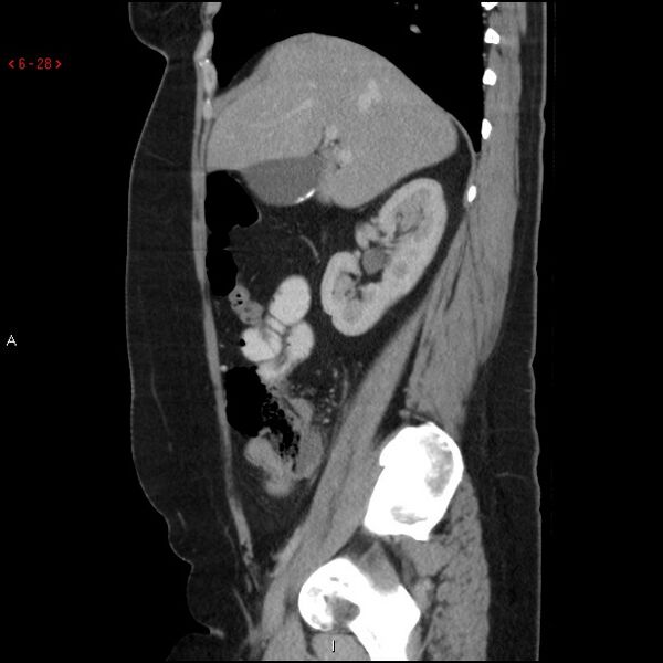 File:Appendicitis with microperforation- promontoric type (Radiopaedia 27268-27442 A 13).jpg