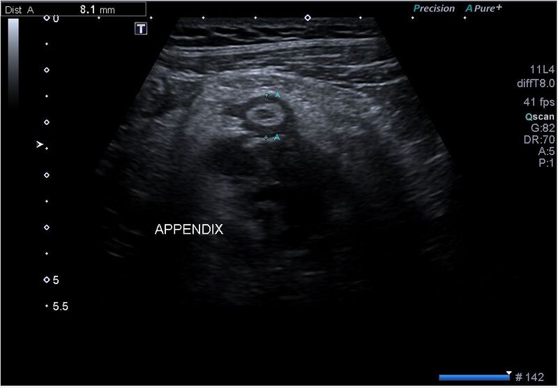 File:Appendicular abscess (Radiopaedia 67249).jpg
