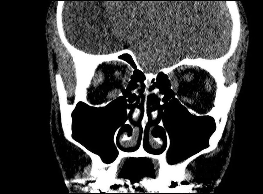 Arachnoid cyst- extremely large (Radiopaedia 68741-78450 Coronal bone window 48).jpg
