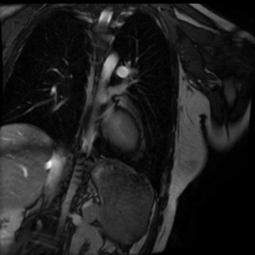 Arrhythmogenic right ventricular cardiomyopathy (Radiopaedia 87505-103850 2ch (LV) Cine SSFP 66).jpg