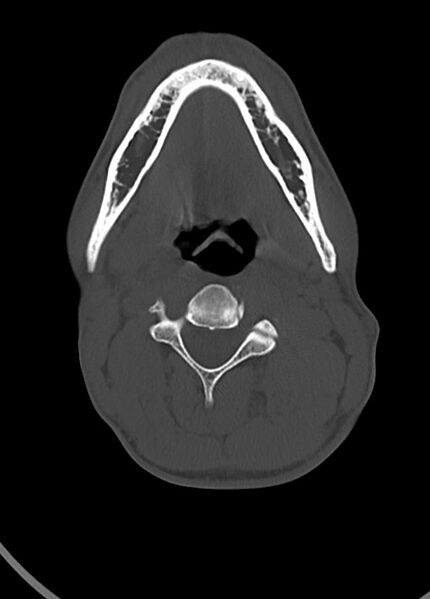 File:Arrow injury to the head (Radiopaedia 75266-86388 Axial bone window 18).jpg