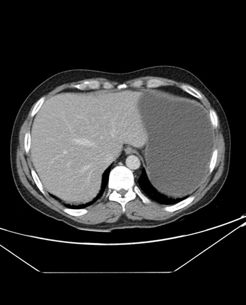 File:Arterial occlusive mesenteric ischemia (Radiopaedia 84641-100054 A 16).jpg