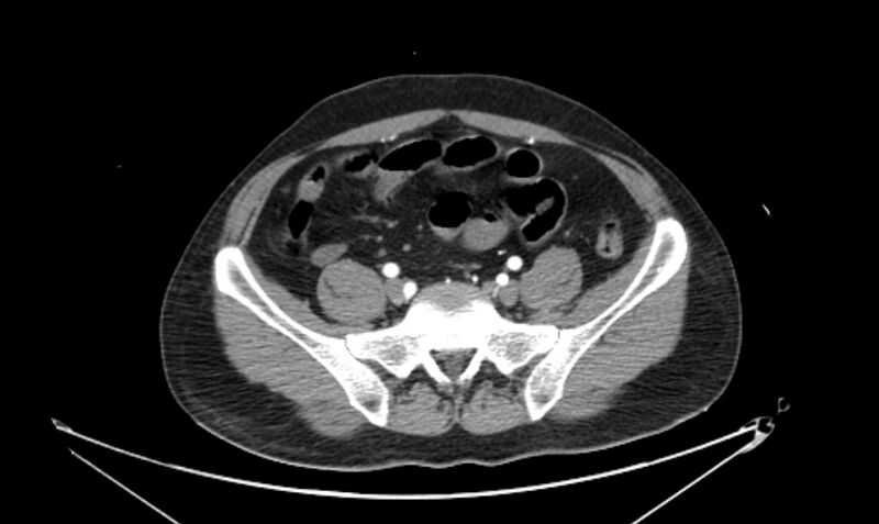 File:Arterial occlusive mesenteric ischemia (Radiopaedia 84641-100060 A 97).jpg