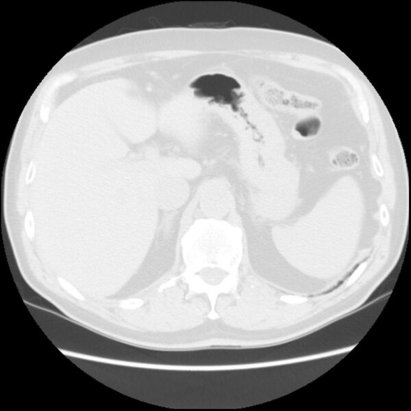 File:Asbestos-related pleural plaques (Radiopaedia 39069-41255 Axial lung window 69).jpg