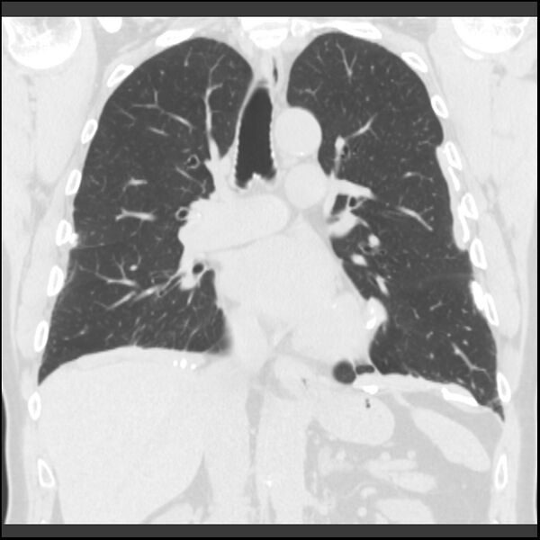 File:Asbestos-related pleural plaques (Radiopaedia 39069-41255 Coronal lung window 45).jpg