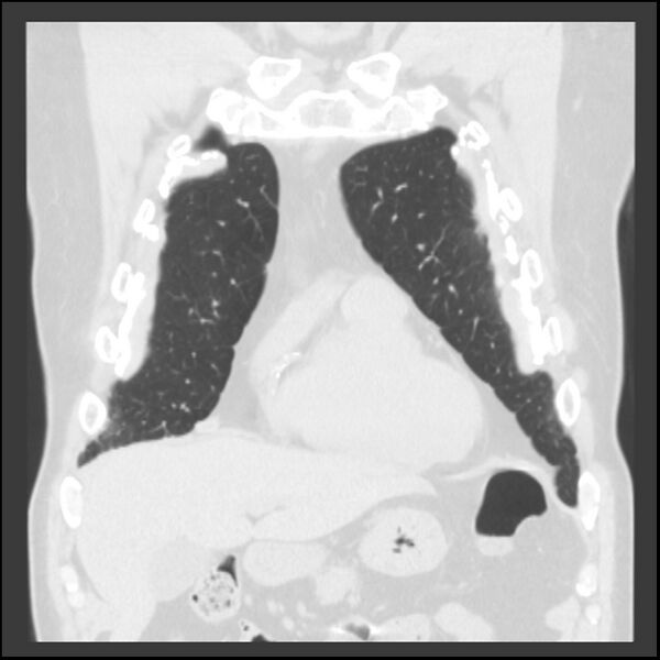 File:Asbestos-related pleural plaques (Radiopaedia 39069-41255 Coronal lung window 69).jpg