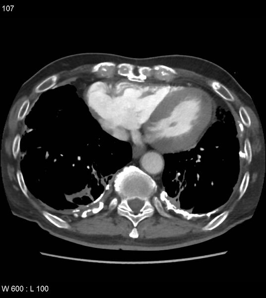 File:Asbestos related lung and pleural disease (Radiopaedia 14377-14301 D 43).jpg