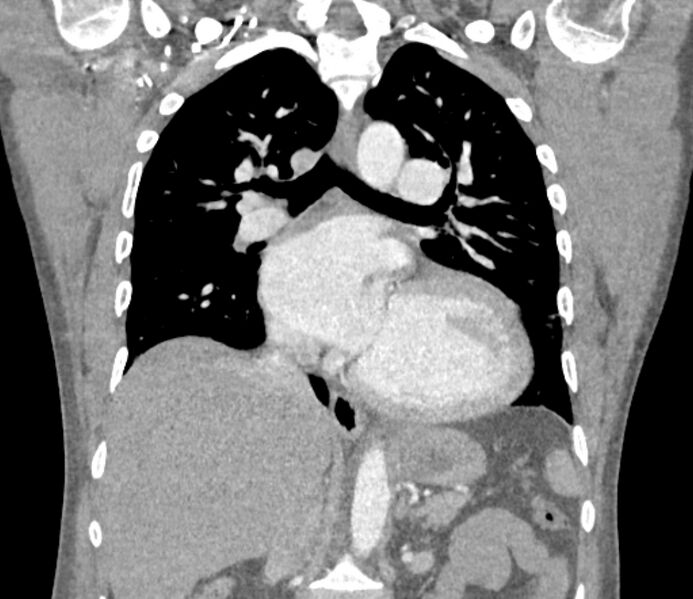 File:Ascending aortic aneurysm (Radiopaedia 86279-102297 B 37).jpg