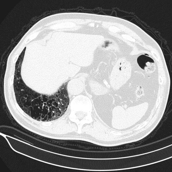 File:Aspergilloma (Radiopaedia 24521-24804 Axial lung window 26).jpg