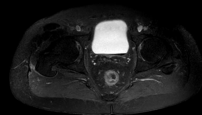Atypical lipomatous tumor - thigh (Radiopaedia 68975-78734 Axial T1 C+ fat sat 93).jpg