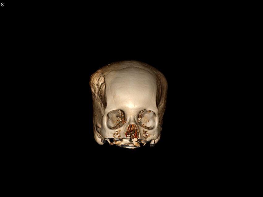 Atypical meningioma - intraosseous (Radiopaedia 64915-73867 3D volume render 8).jpg